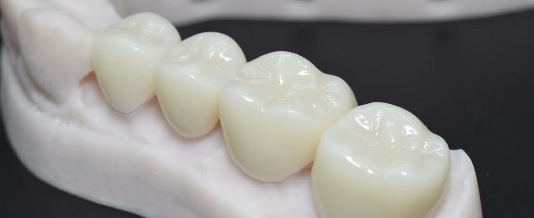 Dental Crowns at Seaview Dental Center: What I Wish More Patients Knew Before Saying Yes
